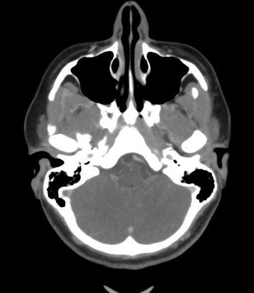 Cerebral venous hemorrhagic infarction (Radiopaedia 38461-40550 Axial MIP VENOGRAM 11).png