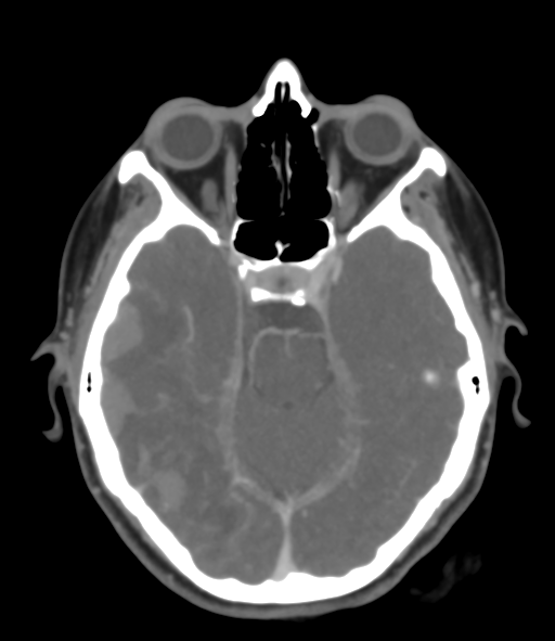 Cerebral venous hemorrhagic infarction (Radiopaedia 38461-40550 Axial MIP VENOGRAM 19).png