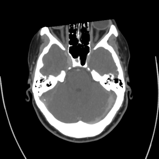 Cerebral venous infarct related to dural venous sinus thromboses (Radiopaedia 35292-36804 Axial C+ delayed 16).png