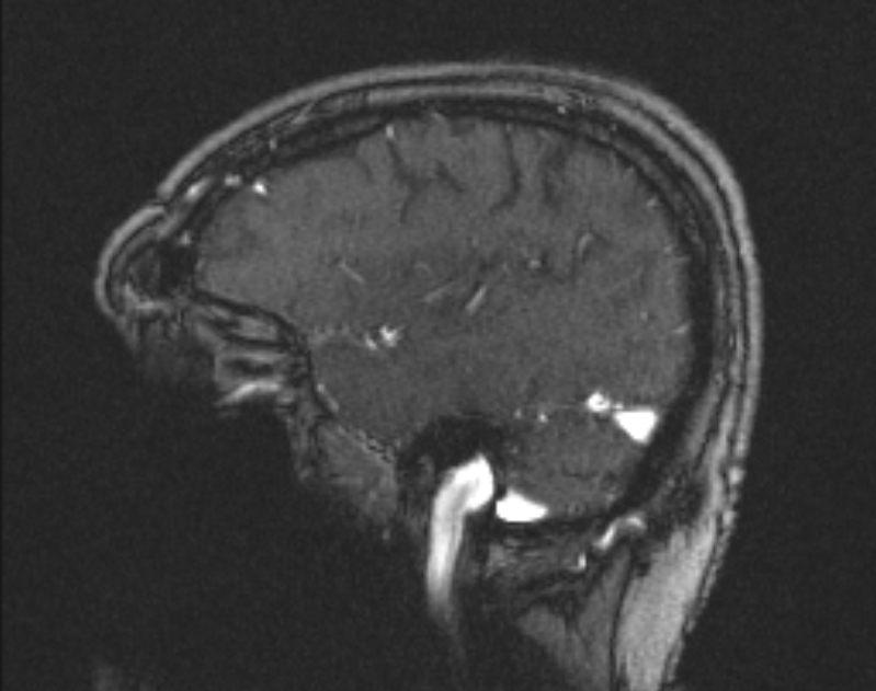 Cerebral venous infarction (Radiopaedia 65166-74176 Sagittal TOF 56).jpg