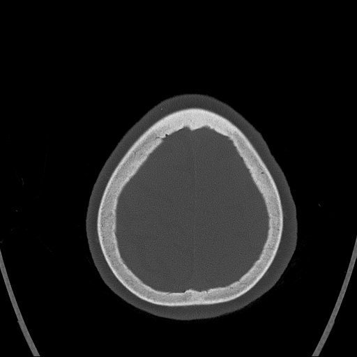 Cerebral venous infarction with hemorrhage (Radiopaedia 65343-74381 Axial bone window 168).jpg