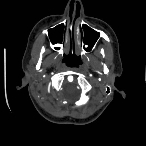 Cerebral venous sinus thrombosis (Radiopaedia 40619-43227 A 17).jpg
