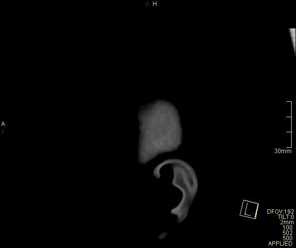 Cerebral venous sinus thrombosis (Radiopaedia 91329-108965 Sagittal venogram 1).jpg