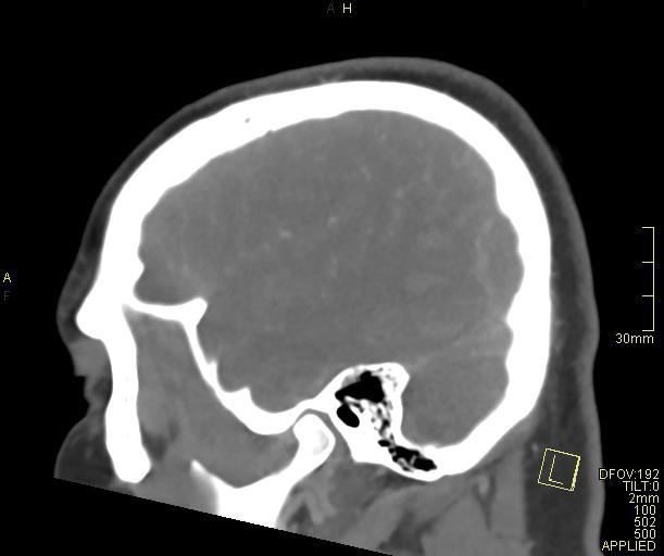 Cerebral venous sinus thrombosis (Radiopaedia 91329-108965 Sagittal venogram 62).jpg