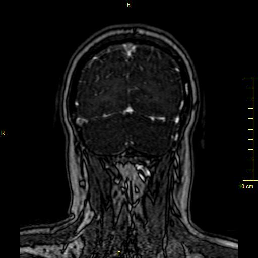 Cerebral venous thrombosis (Radiopaedia 23288-23351 MRV 147).JPG