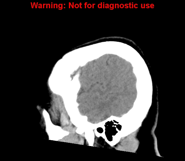 File:Cerebral venous thrombosis (Radiopaedia 37224-38992 B 27).jpg
