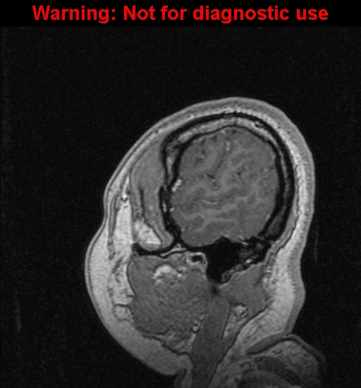 File:Cerebral venous thrombosis (Radiopaedia 37224-39208 Sagittal T1 C+ 136).jpg