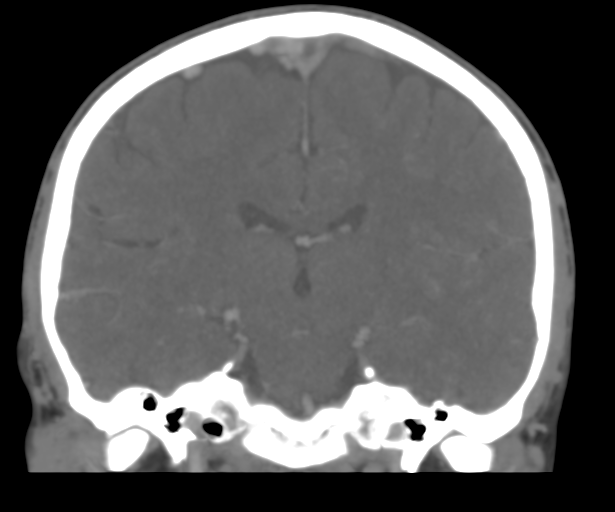 Cerebral venous thrombosis (Radiopaedia 38392-40467 Coronal CTA-Venogram 35).png