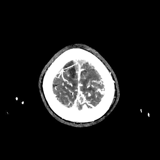 File:Cerebral venous thrombosis - hemorrhagic venous infarction (Radiopaedia 87318-103613 Axial 210).jpg