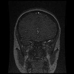 Cerebral venous thrombosis - ulcerative colitis (Radiopaedia 66049-75219 Coronal MRV 84).jpg
