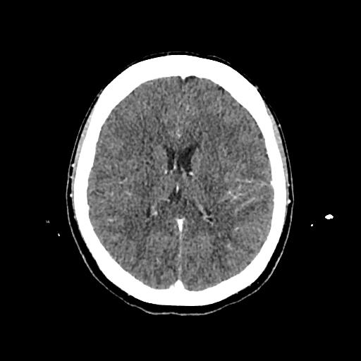 File:Cerebral venous thrombosis with venous hemorrhagic infarct (Radiopaedia 90354-107660 Axial with contrast 99).jpg