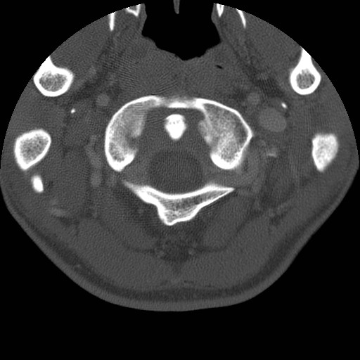 Cervical Pott disease (Radiopaedia 20374-20286 Axial bone window 18).jpg
