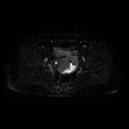 File:Cervical carcinoma (Radiopaedia 67644-77047 Axial DWI 35).jpg