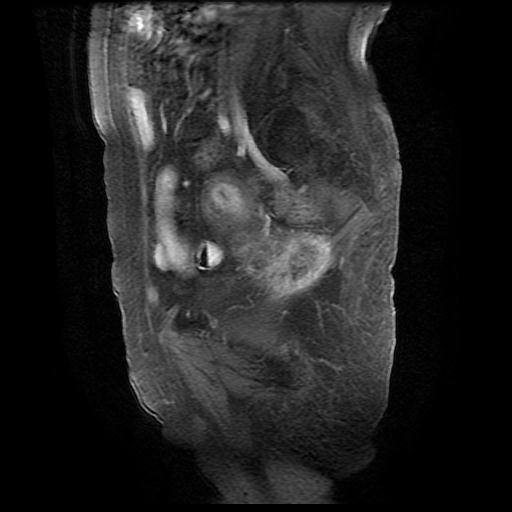 File:Cervical carcinoma (Radiopaedia 78847-91705 I 5).jpg