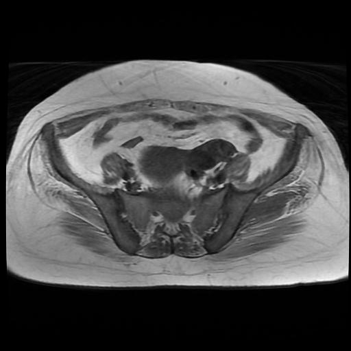 File:Cervical carcinoma (Radiopaedia 88010-104555 Axial T1 5).jpg