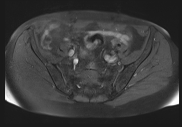 File:Cervical carcinoma (Radiopaedia 88312-104943 Axial T1 fat sat 7).jpg