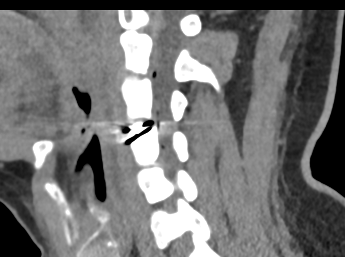 Cervical disc replacement (Radiopaedia 44025-47541 B 57).png
