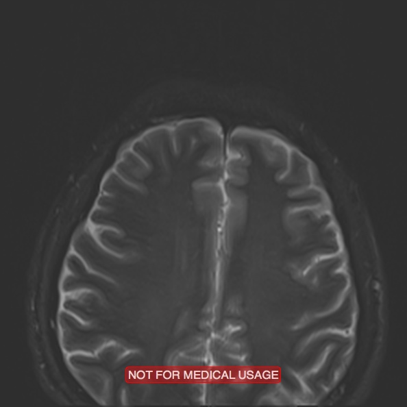 Cervical nerve schwannoma (Radiopaedia 27964-28221 C 1).jpg