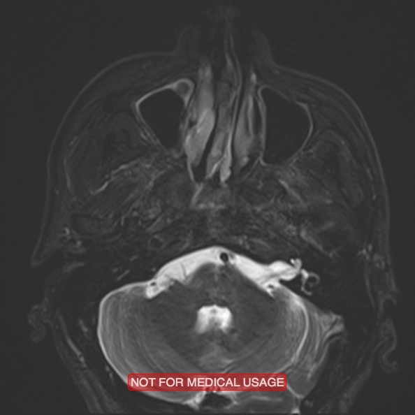 Cervical nerve schwannoma (Radiopaedia 27964-28221 C 14).jpg