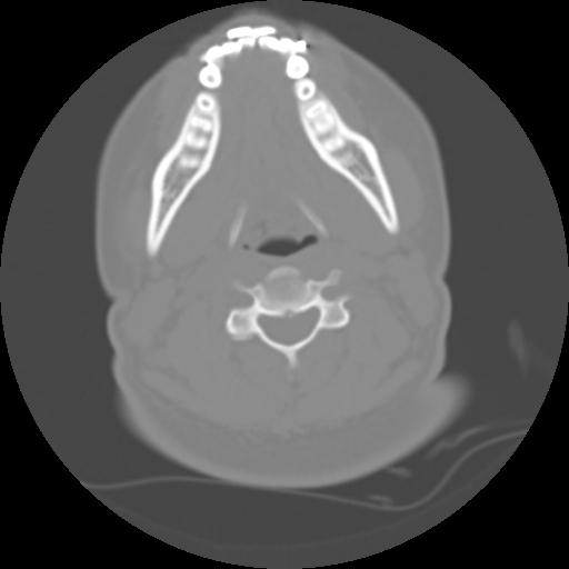 Cervical rib (Radiopaedia 71110-81363 Axial non-contrast 29).jpg