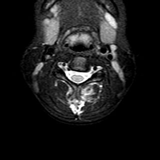 File:Cervical spine posterior ligamentous complex rupture (Radiopaedia 63486-72103 Axial T2 15).jpg