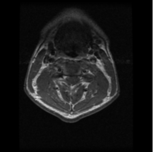 File:Cervical vertebrae metastasis (Radiopaedia 78814-91667 Axial T1 C+ 14).png