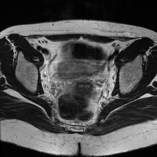 File:Cesarian section scar endometriosis (Radiopaedia 66520-75799 Axial T2 13).jpg