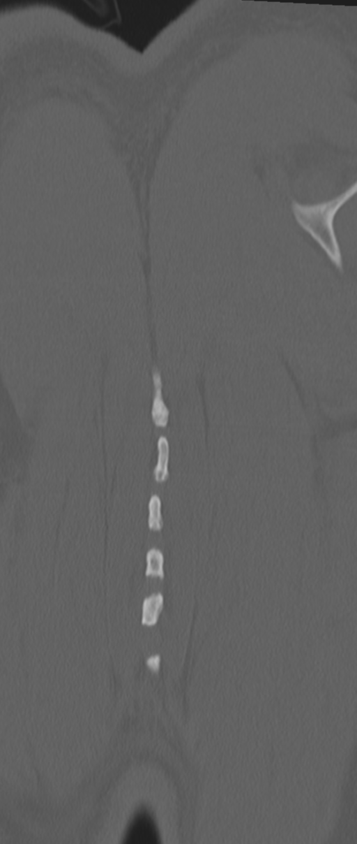 Chance fracture (Radiopaedia 33854-35020 Coronal bone window 85).png