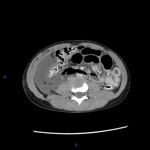 File:Chance fracture with duodenal and pancreatic lacerations (Radiopaedia 43477-46864 A 24).jpg