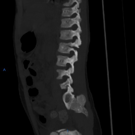 File:Chance fracture with duodenal and pancreatic lacerations (Radiopaedia 43477-50042 Sagittal bone window 5).jpg