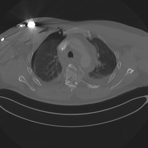 Chest multitrauma - aortic injury (Radiopaedia 34708-36147 Axial bone window 93).png