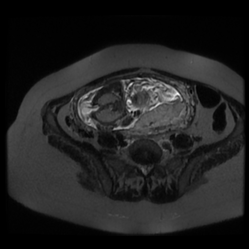 Chiari II malformation - fetal MRI (Radiopaedia 68099-77581 Axial T2-SSFSE 32).jpg