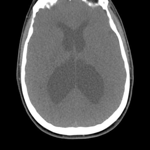 Chiari I malformation and obstructive hydrocephalus (Radiopaedia 41185-43981 D 8).png