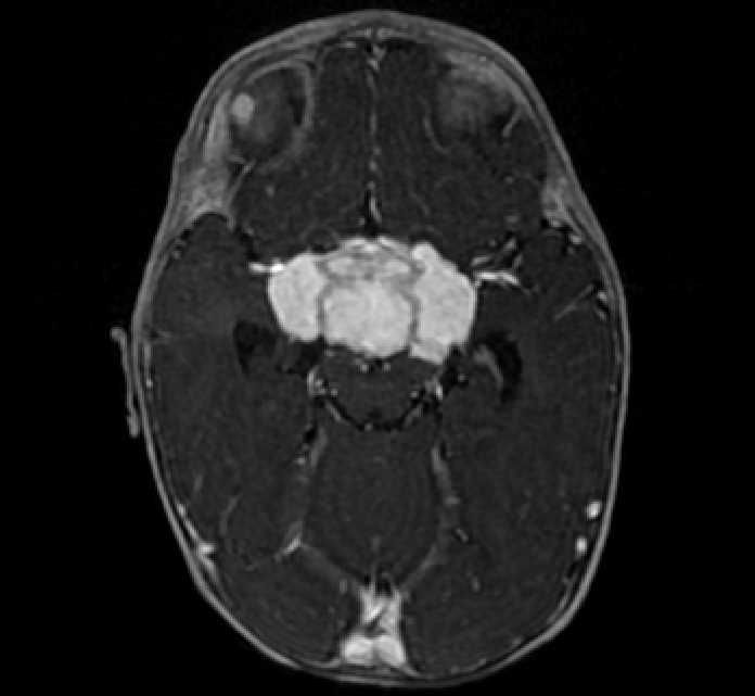 Chiasmatic-hypothalamic glioma (Radiopaedia 90079-107252 Axial T1 C+ 32).jpg