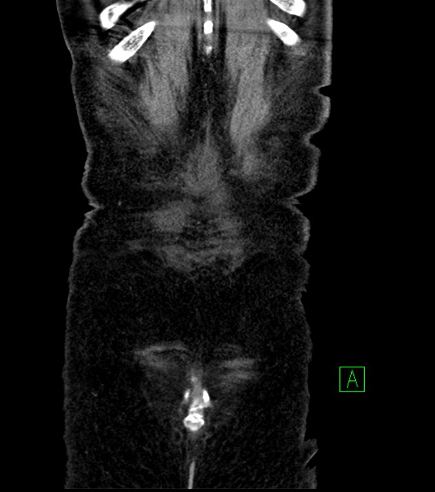 Cholangiocarcinoma with cerebral metastases (Radiopaedia 83519-98629 G 80).jpg