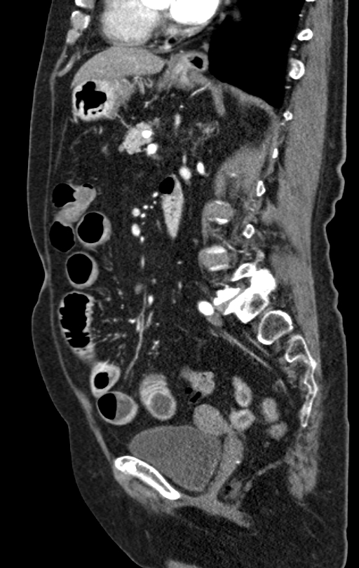 Cholecystoduodenal fistula due to calculous cholecystitis with gallstone migration (Radiopaedia 86875-103077 C 27).jpg