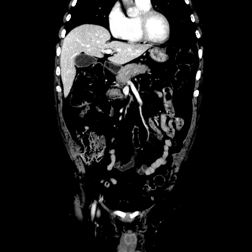 Choledocholiathiasis with normal caliber common bile duct (Radiopaedia 75368-86632 Coronal liver window 46).jpg