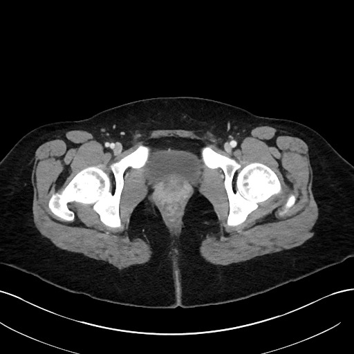 File:Choledocholithiasis after recent cholecystectomy (Radiopaedia 60929-68737 Axial 62).jpg