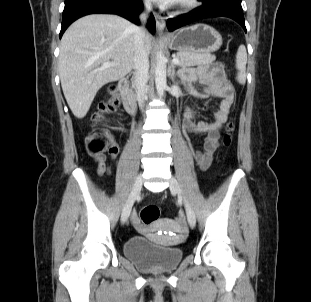 Choledocholithiasis on CT and MRI (Radiopaedia 24825-25087 C 27).jpg