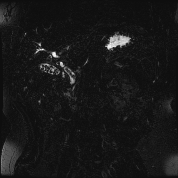 Choledocholithiasis on CT and MRI (Radiopaedia 24825-25088 Coronal T2 33).jpg
