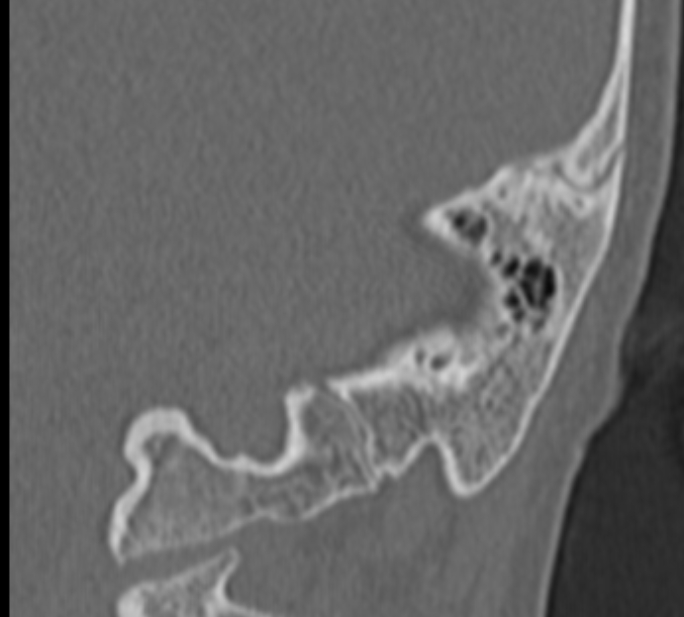 Cholesteatoma (Radiopaedia 73023-83750 Coronal Left ear 69).jpg