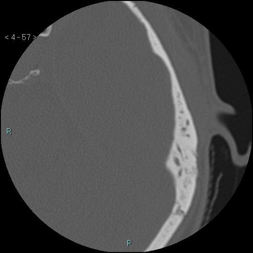 File:Cholesterol granuloma of the petrous apex (Radiopaedia 64358-73141 Axial bone window 28).jpg