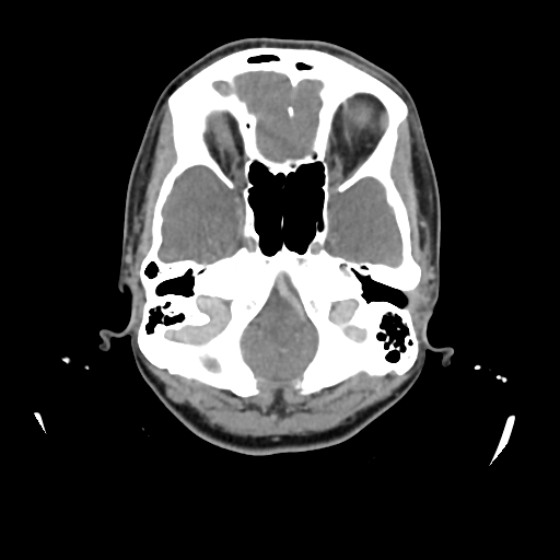 File:Chondroblastic osteosarcoma (Radiopaedia 67363-76741 Axial with contrast 39).jpg