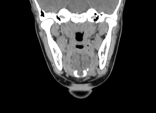 File:Chondroblastic osteosarcoma (Radiopaedia 67363-76741 D 59).jpg