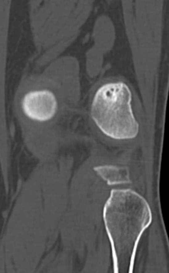 Chondrocalcinosis (Radiopaedia 82862-97173 Coronal bone window 64).jpg