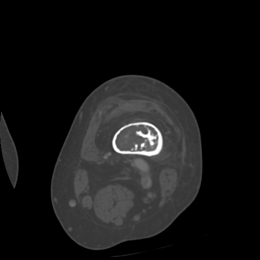 Chondrosarcoma - femur (Radiopaedia 64187-72954 Axial bone window 18).jpg