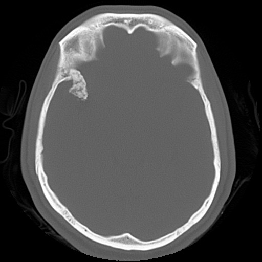 File:Chondrosarcoma - sphenoid wing (Radiopaedia 58259-67828 Axial bone window 11).jpg