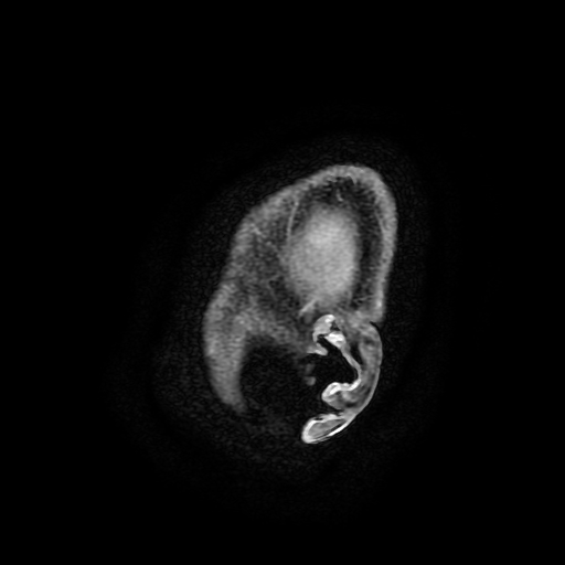 Chordoid glioma of third ventricle (Radiopaedia 91612-109340 F 202).jpg