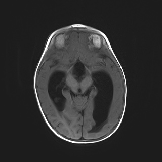 File:Choroid plexus papilloma (Radiopaedia 84612-100019 Axial T1 11).jpg