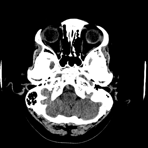 Choroid plexus xanthogranulomas (Radiopaedia 51621-57408 Axial non-contrast 15).jpg